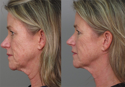 Ultherapy Face and Neck Treatment in Santa Fe NM