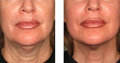 Ultherapy Lower Face and Neck Treatment Santa Fe NM