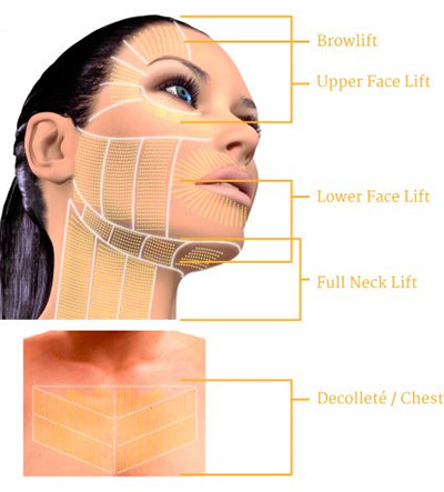 Ultherapy Treatment Areas