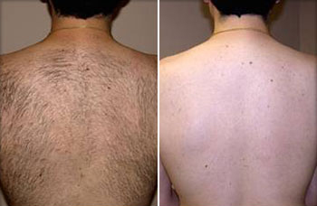 Male Back Laser Hair Removal Santa Fe NM