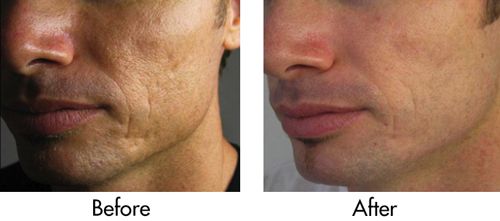 Male Microneedling Results